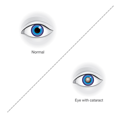 Cataract Management