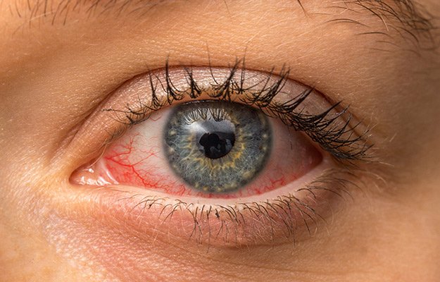 Dry Eye Exam