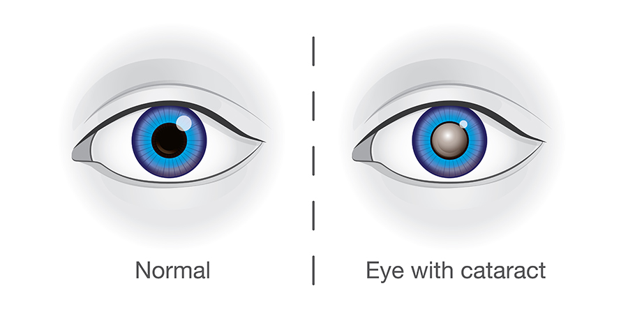 Cataract Management
